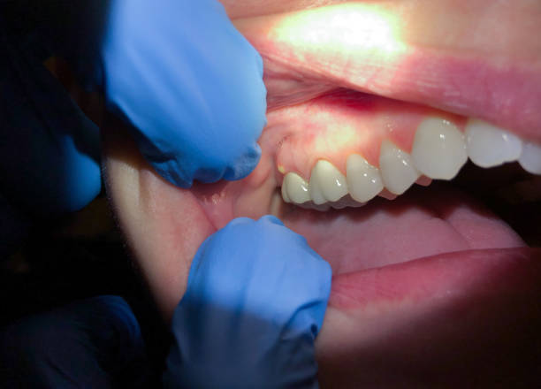 Best Teeth Whitening  in Capitol Heights, MD